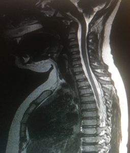 MRI Scan Matt Tozer 3